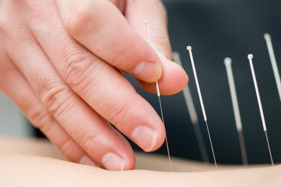 Akupunktur | Dr. med. Susanne Krebber